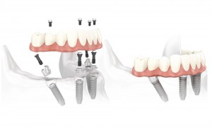 implante dental carga inmediata implante dental de carga inmediata