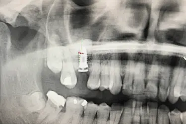 Radiografía dental con implante y medición del hueso regenerado tras injerto óseo