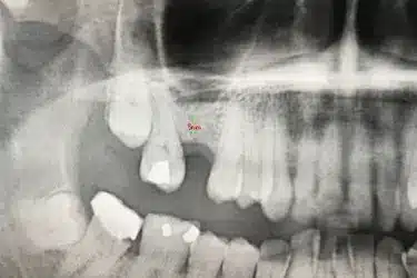 Radiografía dental con medición que muestra falta de hueso para implantes dentales