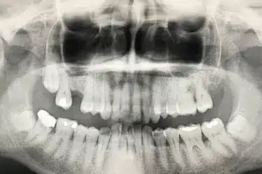 Radiografía dental que muestra falta de hueso para colocar implantes dentales
