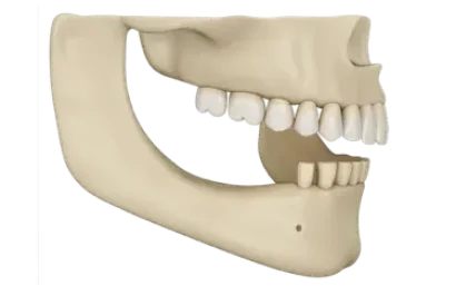 Implante dental sin hueso en mandíbula inferior explicado con imagen 3D profesional
