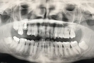 Radiografía dental con implante tras regeneración ósea y medición del hueso disponible
