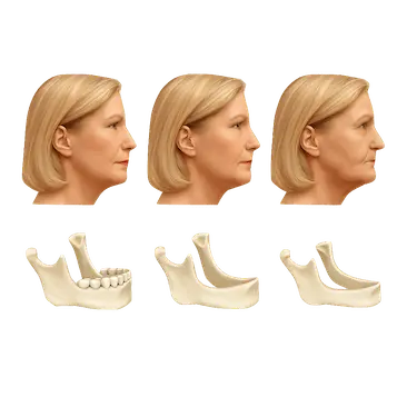 Evolución de la reabsorción ósea mandibular con pérdida progresiva de hueso dental