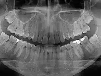 Radiografía panorámica dental para diagnóstico y planificación de tratamientos odontológicos