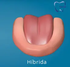 Prótesis dental híbrida acrílica sobre implantes para recuperar función y estética dental