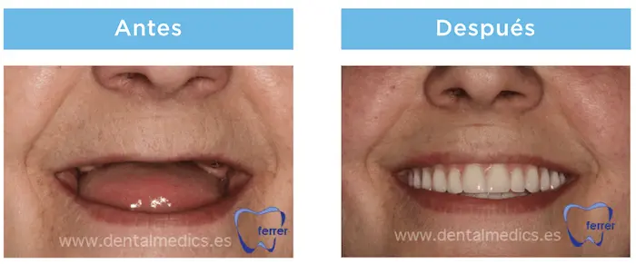 Antes y después de prótesis dental híbrida sobre implantes con mejora estética y funcional