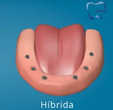 Prótesis dental híbrida sobre implantes para restaurar la estética y la función masticatoria