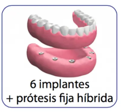 Precio orientativo de prótesis híbrida sobre seis implantes dentales