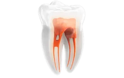 Endodoncia en diente multirradicular con limpieza y sellado de los conductos radiculares