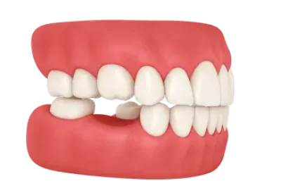 Comparativa entre implante dental y puente fijo para sustituir un diente perdido
