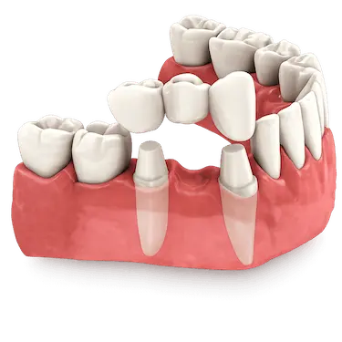 Puente dental fijo sobre dientes naturales con tallado de las piezas adyacentes