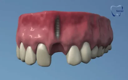 Proceso de colocación de implantes dentales con las fases del tratamiento quirúrgico