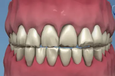 Dientes desgastados por bruxismo y encías retraídas en ilustración dental 3D