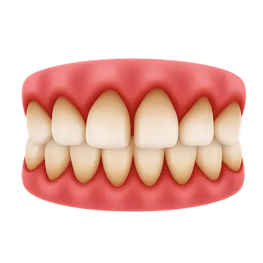 Encías retraídas con raíz dental expuesta por pérdida de tejido gingival