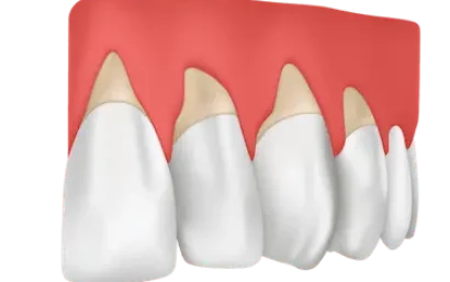 Ilustración 3D de encías retraídas con raíces expuestas y pérdida de tejido gingival