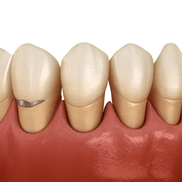 Encías retraídas por periodoncia y bruxismo con raíces dentales expuestas