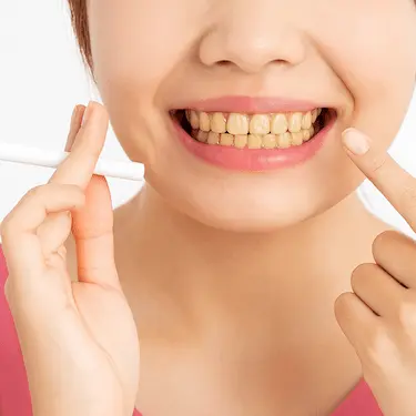 Encías retraídas y dientes amarillentos por consumo de tabaco y problemas periodontales