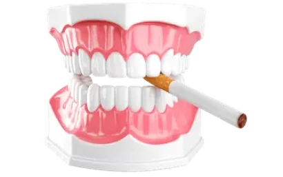 Modelo dental con cigarrillo explicando el tiempo sin fumar tras implantes dentales