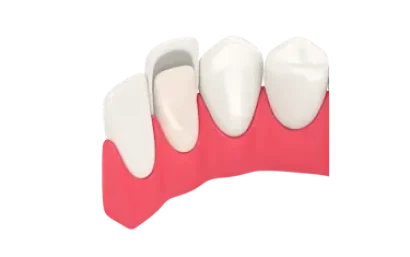 Carillas dentales colocadas sobre los dientes, cuidados y mantenimiento para conservar su estética