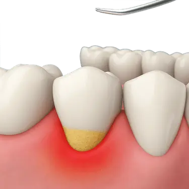 Ilustración 3D de raspado radicular para eliminar sarro bajo la encía y tratar periodontitis