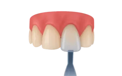 Carilla dental colocada sobre diente natural, imagen ilustrativa del precio del tratamiento