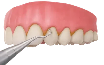 Ilustración de curetaje dental para explicar el tratamiento periodontal y su precio