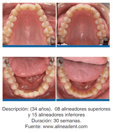 Antes y después del tratamiento de ortodoncia con alineadores Alineadent en el paciente