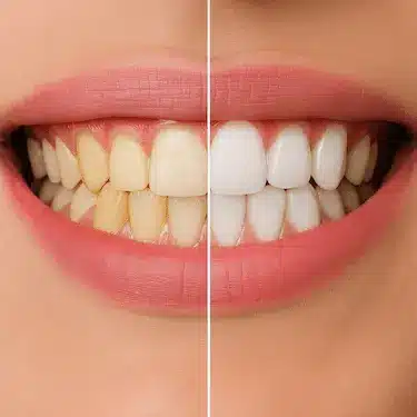Antes y después de blanqueamiento dental en casa con férulas personalizadas