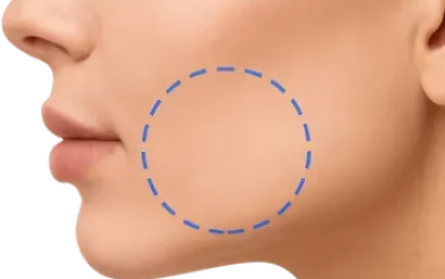 Zona facial marcada para intervención de bichectomía en Madrid en Clínica Dental Medics Dr. Ferrer