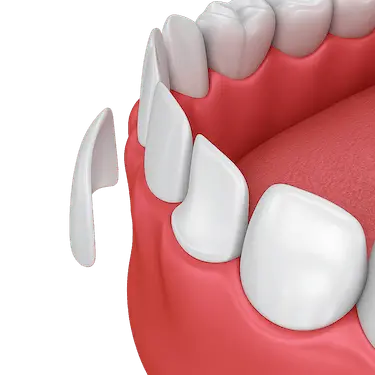 Esquema dental que muestra qué son las carillas de composite y cómo se adhieren al diente