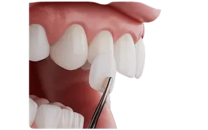 Carillas de composite para mejorar forma, color y estética dental de manera conservadora
