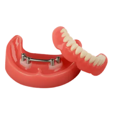 Modelo de sobredentadura con barra y sistema locator que ilustra el precio del tratamiento