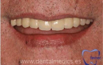 Resultado final de implantes dentales en toda la boca con prótesis dental completa sobre implantes