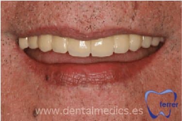 Resultado final de implantes dentales en toda la boca con prótesis dental completa sobre implantes
