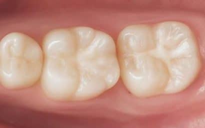 Aplicación de sellador dental para reducir la sensibilidad y proteger el esmalte