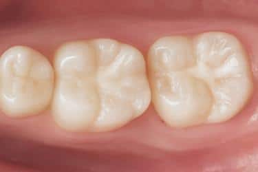 Aplicación de sellador dental para reducir la sensibilidad y proteger el esmalte