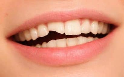 Diente roto visible en la sonrisa, ejemplo de fractura dental que requiere tratamiento