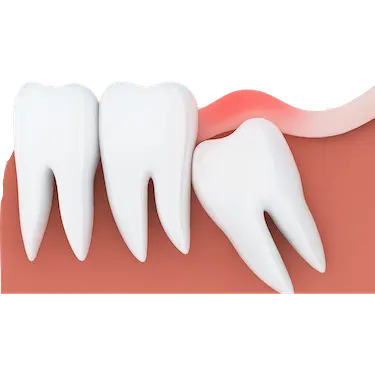 Muela del juicio inclinada causando presión e inflamación en la encía, ilustración 3D