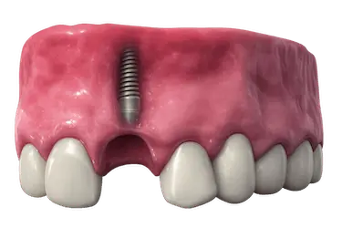 Implante dental de marca premium colocado en el hueso con encía sana