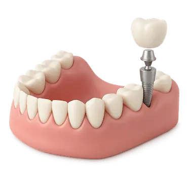 Implante dental con carga inmediata y corona provisional, técnica que influye en el precio