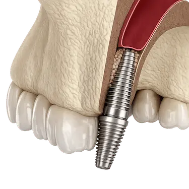 Elevación de seno maxilar con implante dental, técnica que influye en el precio del tratamiento