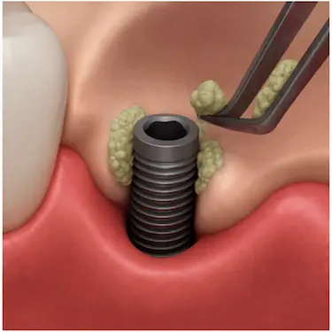 Injerto de hueso alrededor de implantes dentales que puede influir en el precio del tratamiento