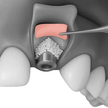 Membrana de colágeno reabsorbible sobre injerto óseo en implantes dentales