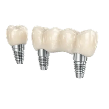 Prótesis provisional de resina sobre implantes dentales como solución temporal