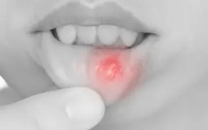 Llaga o afta bucal en labio inferior tratada en Clínica Dental Dr. Ferrer