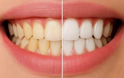 Antes y después de un blanqueamiento dental en Madrid