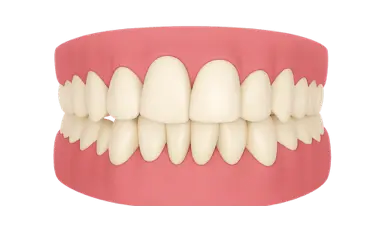 Dientes amarillentos antes de un tratamiento de blanqueamiento dental en Madrid