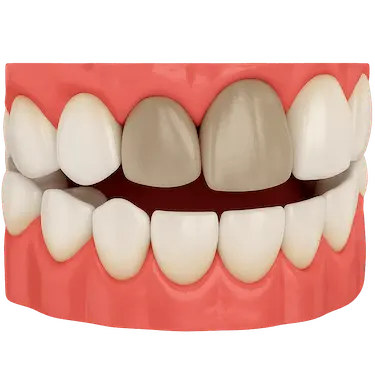 Modelo dental mostrando diente oscurecido tratado con blanqueamiento interno en Madrid