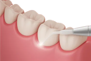 Cirugía periodontal para eliminar bolsas profundas y controlar la infección de las encías