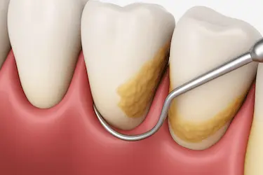 Tratamiento periodontal para eliminar placa profunda y reducir el mal aliento